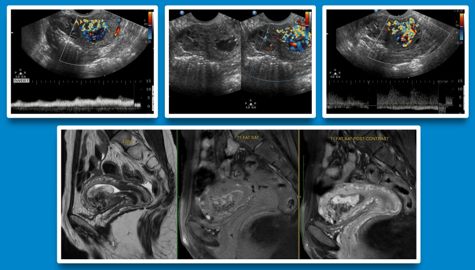 Diagnosis - Uterine Arterio - Venous Malformation