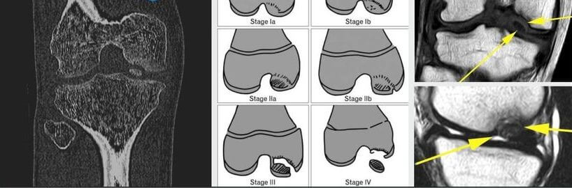 Osteochondritis Dissecans