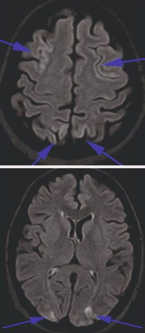 Posterior Reversible Encephalopathy Syndrome (PRES)