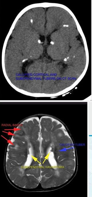 Tuberous Sclerosis